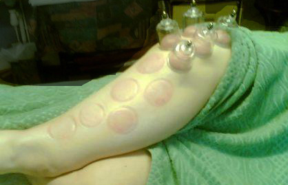 Cupping used for Sciatica Cupping Therapy - &copy; Copyright Holistic Tranquillity Coventry