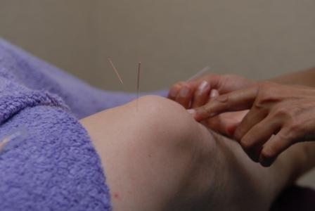 Acupuncture &copy; Copyright Holistic Tranquillity 2006
