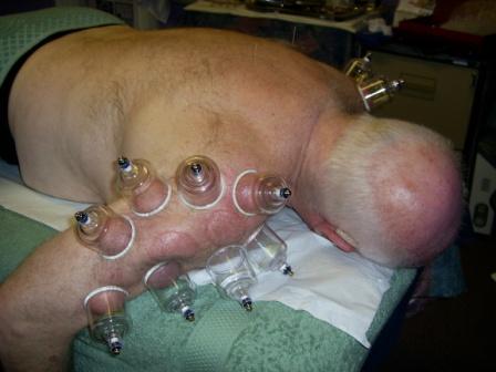 Frozen Shoulder Cupping Therapy - &copy; Copyright Holistic Tranquillity Coventry