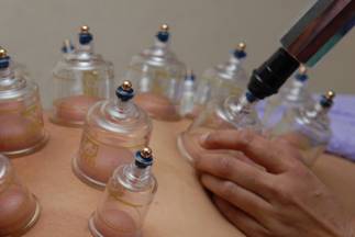 Cupping techniqueCupping Therapy - &copy; Copyright Holistic Tranquillity Coventry